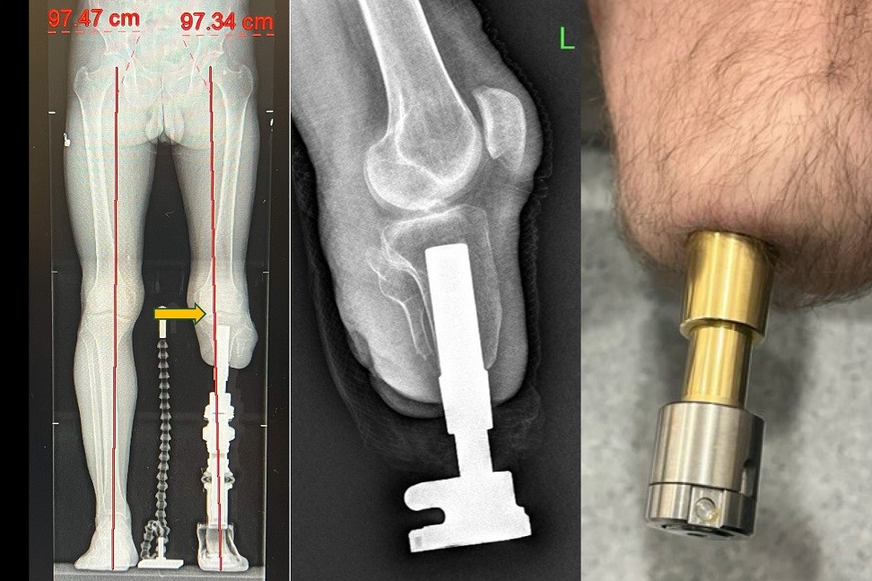 Yürümek artık hayal değil! Türkiye’de Yeni Dönem Başladı