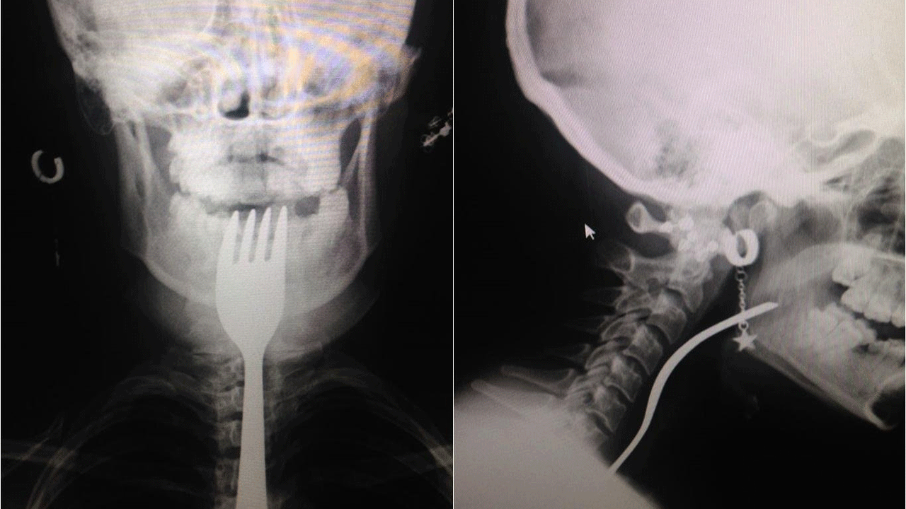 Yuttuğu çatalın ilginç hikayesi! Bilim dünyasına girecek