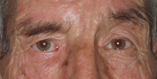 Yüz felcine karşı alınacak önlemler nelerdir?