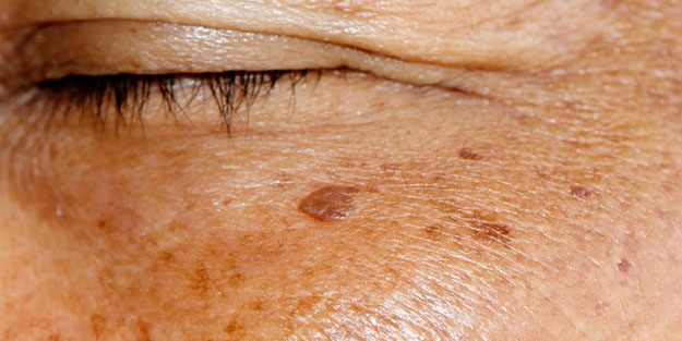 Öğlen bilinçsiz güneşlenmek, yüzde lekelere davetiye çıkarıyor