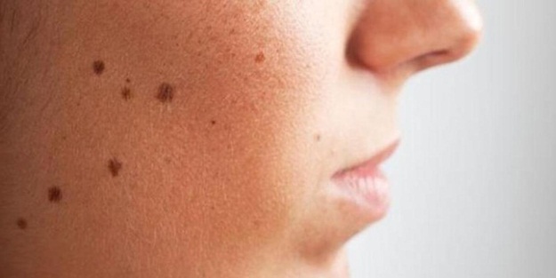 Yüzdeki benler nasıl geçer? Suya atıp bir gece bekletin