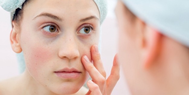 Yüzdeki küçük beyaz noktalardan nasıl kurtulursunuz?
