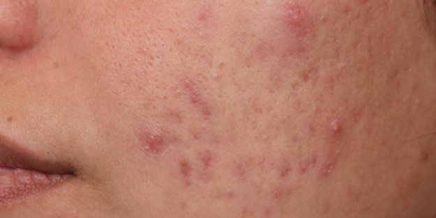 Yüzdeki o sivilcelere dikkat! Hastalığın habercisi olabilir...
