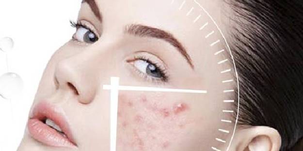 Yüzdeki sivilce lekeleri nasıl geçer?