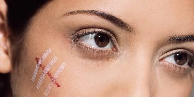 Yüzdeki yara izleri nasıl geçer? Doğal reçete