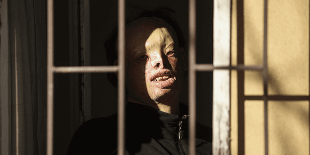 Yüzü yanan genç yardım bekliyor: İnsanların bana acıyarak bakmasını istemiyorum