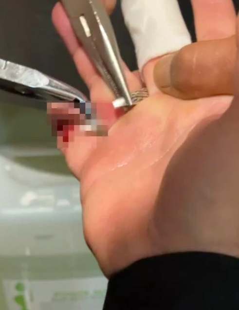 Yüzüğünü çıkaramayınca itfaiye çağırdı!