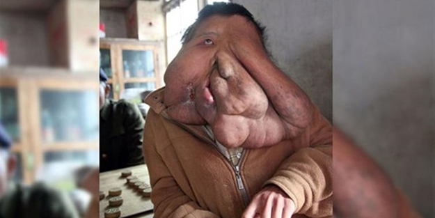 Yüzünde 15 kiloluk tümörle yaşıyor