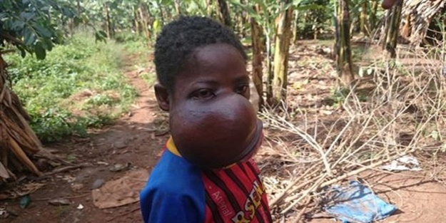 Yüzündeki dev tümör nedeniyle nefes alamıyor