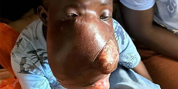 Yüzündeki tümör tüm hayatını mahvetti!