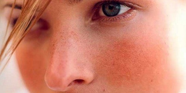 Yüzünüzdeki bu pembeleşme ciddi