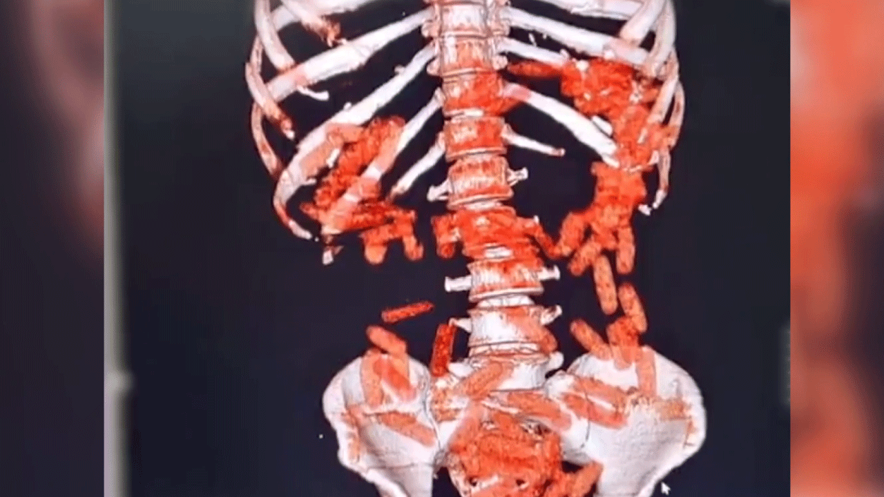 Zanlının midesinden çıkanlar şoke etti