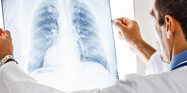 Zatürre nedir? Zatürre belirtilerin neler ve Zatürre nasıl tedavi edilir?