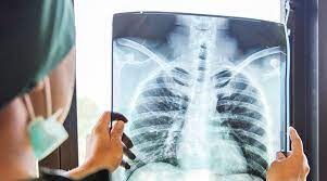 Zatürreden nasıl korunulur?