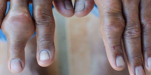 Zengin hastalığı olarak biliniyordu!