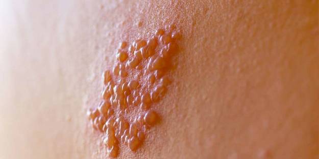  Zona hastalığı ve saç dökülmesi arttı