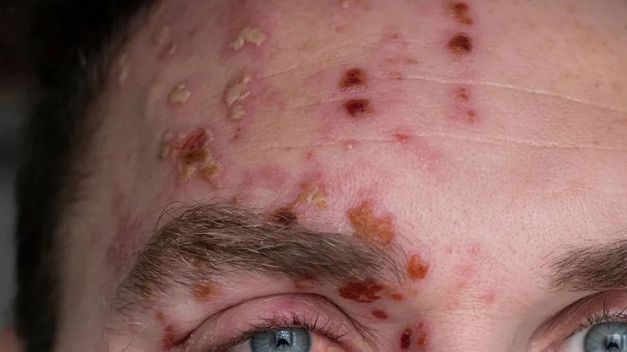 Zona nedir? Evde zona tedavisi nasıl yapılır?