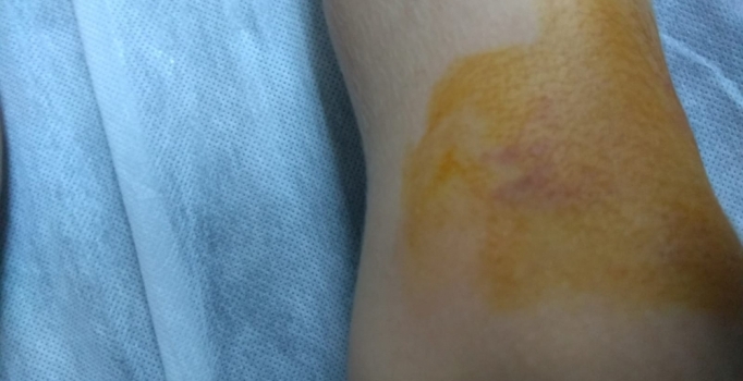 Zonguldak'ta 4 yaşındaki çocuğu yılan ısırdı