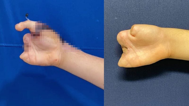 5 parmağını kıyma makinesine kaptırmıştı! Ayak parmağından eline başparmağı yapıldı