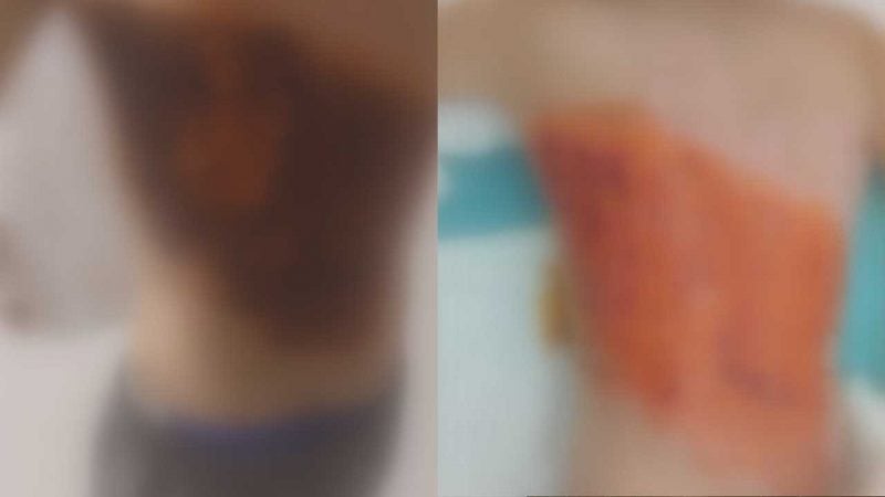 Arnavutköy’de 12 yaşındaki çocuğun ateşe verildiği iddiası: Tedavisi sürüyor
