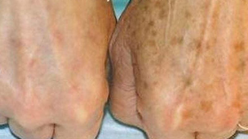 Eldeki kahverengi lekeler nasıl giderilir? Bakım için en iyi krem bu: Bir şey olmaz deyip geçmeyin