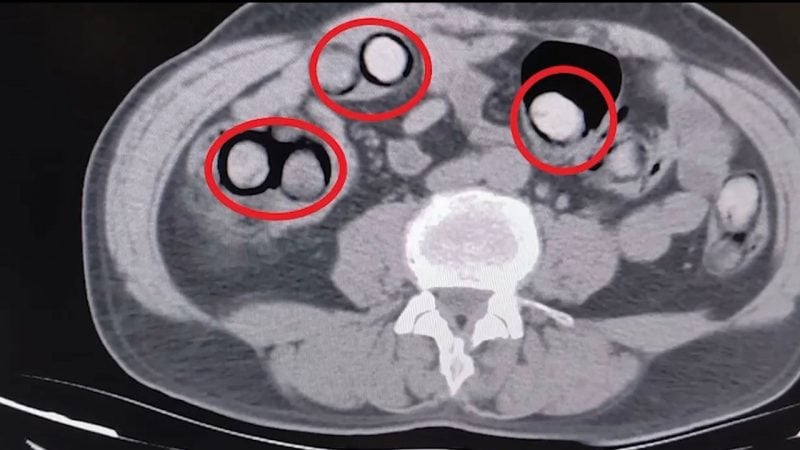 Röntgende ortaya çıktı! Mide ve bağırsaklarında 101 parça uyuşturucu bulundu