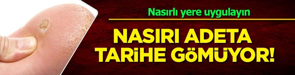 1 Günde nasırı yok edin: Korunmak için 3 kere nasırlı yere uygulayın! Ev yapımı tarif, mücadele ediyor 