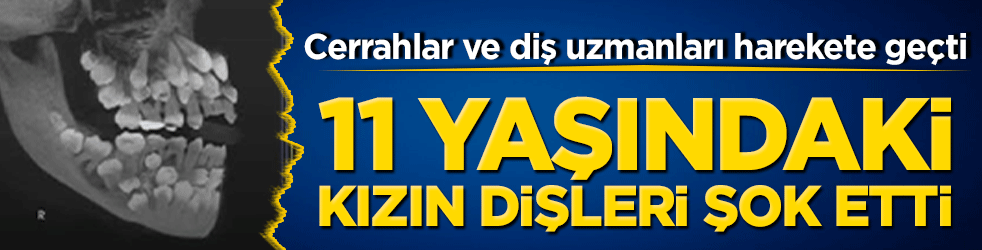 11 yaşındaki kız çocuğunda nadir diş anomalisi! Cerrahlar ve diş uzmanları harekete geçti