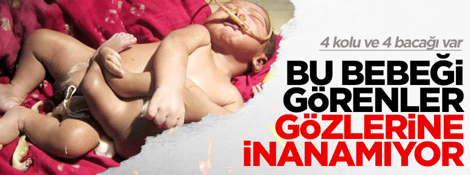 4 kol ve 4 bacaklı bir bebek doğdu