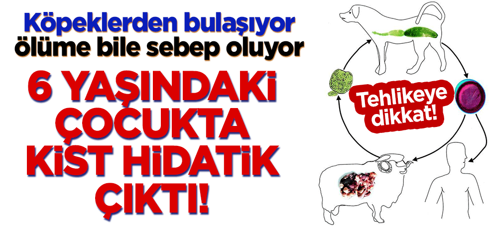 6 yaşındaki çocukta kist hidatik çıktı! Köpeklerden bulaşıyor, ölüme bile sebep oluyor