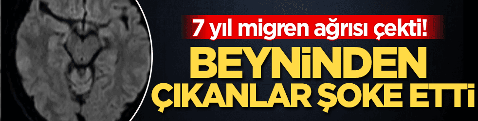 7 yıl migren ağrısı çekti! Beyninden çıkanlar şoke etti