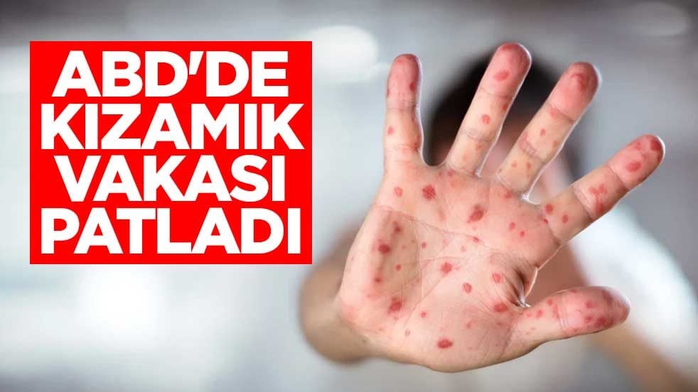ABD'de kızamık vakası patladı