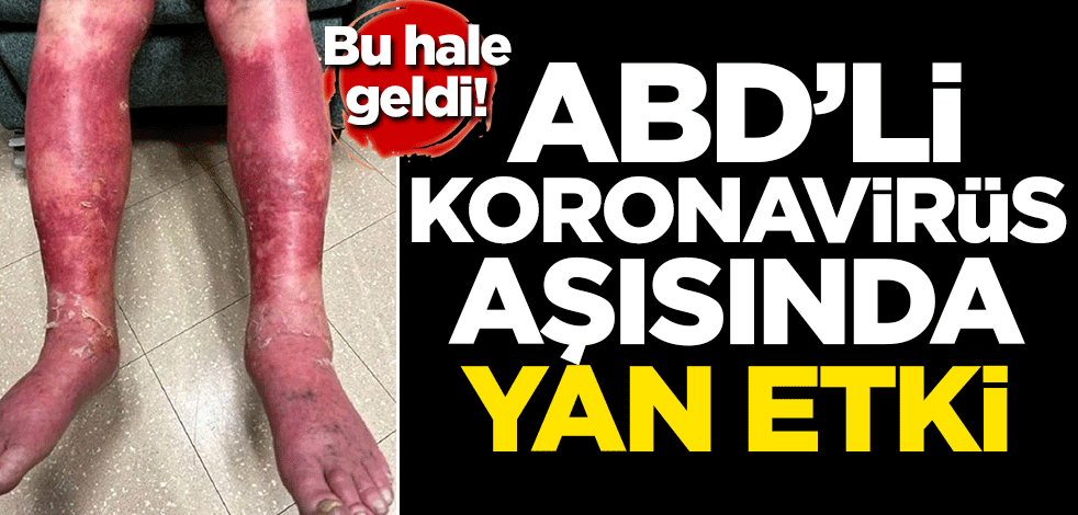 ABD'li koronavirüs aşısında yan etki! Bu hale geldi