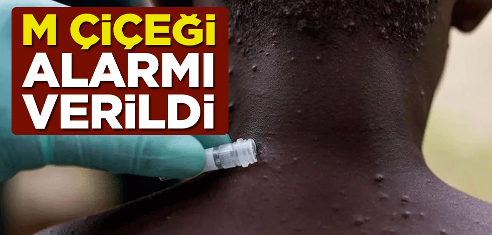 Afrika'da M çiçeği alarmı verildi