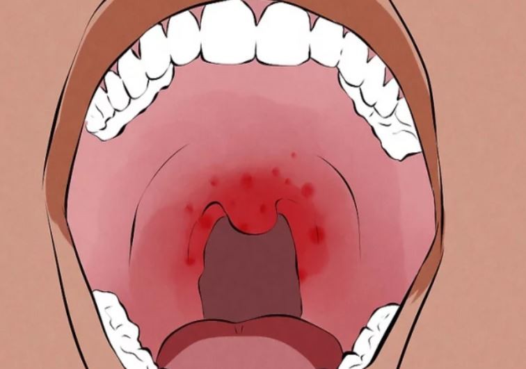 Ağız içi kanseri belirtileri nelerdir?