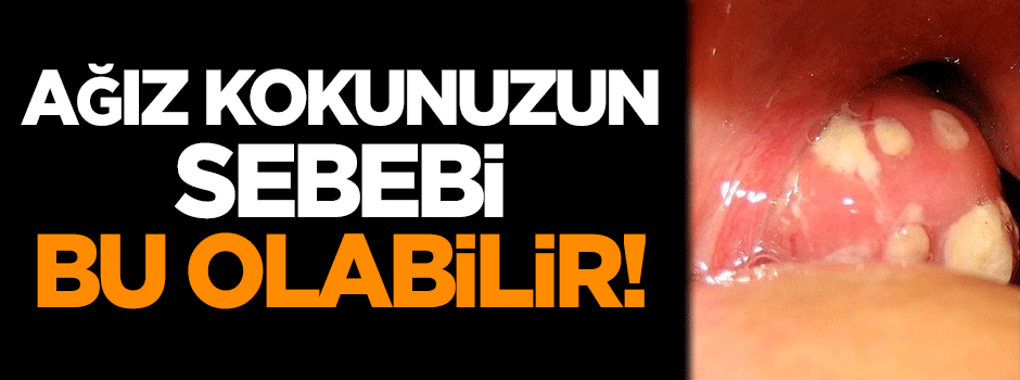Ağız kokunuzun sebebi bu olabilir!