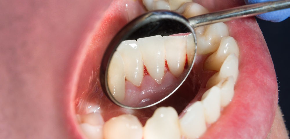 Ağızda metal tadı neden olur? | "Ağzımda metal tadı var"