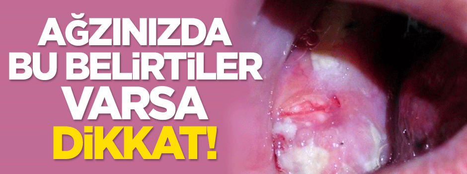 Ağzınızda bu belirtiler varsa dikkat!