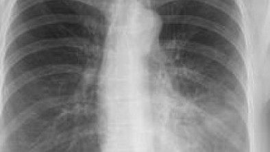 Akciğer sönmesi ne demek? Akciğer sönmesi nasıl bir hastalık belirtileri neler?