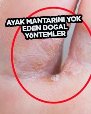 Ayak Mantarını yok eden doğal yöntemler: O ikiliyi karıştırıp sürün yeter! İşte merak edilen sorunun cevabı