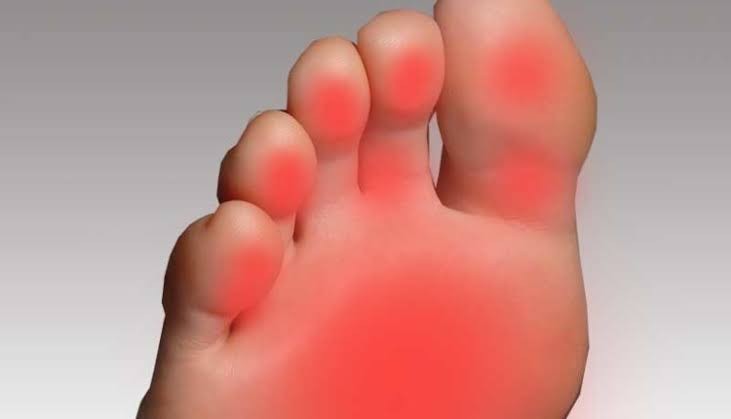Ayak yanması nasıl geçer? Ayak yanması için hangi doktora gidilmeli?