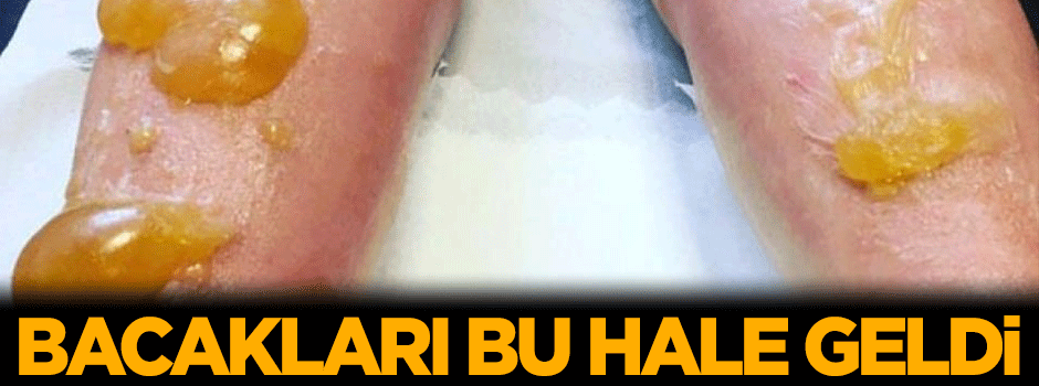 Bacakları bu hale geldi