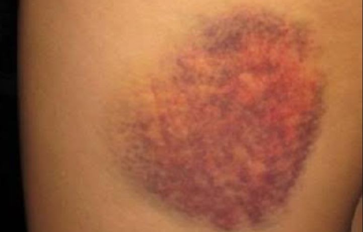 Bacakta morarma nasıl geçer, vücut morarması neden olur?