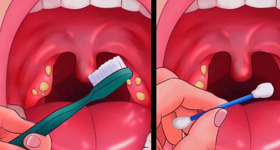 Bademcik taşları nedir?