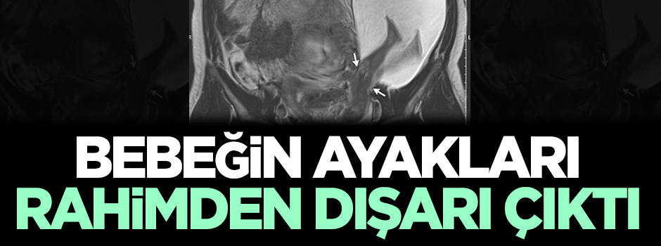 Bebeğin ayakları rahimden dışarı çıktı!