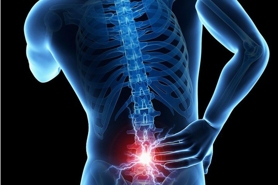 Bel kayması nedir? Bel kayması nasıl düzeltilir?