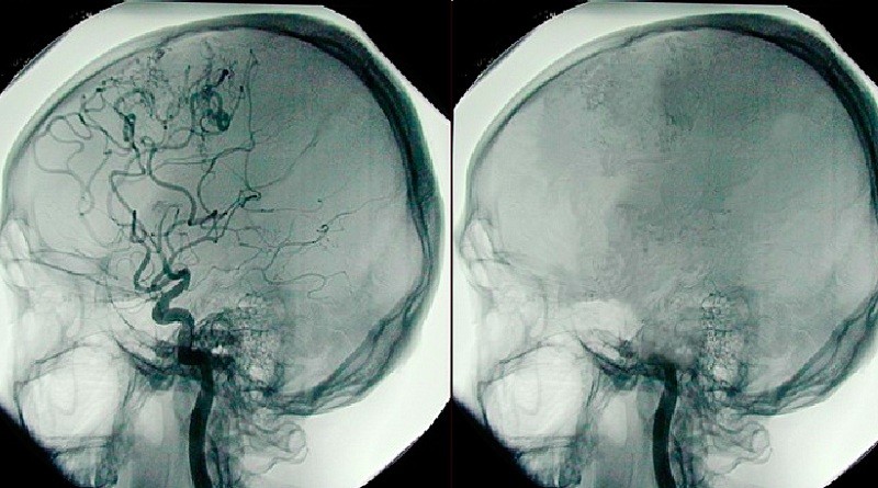 Beyin ölümü ne anlama gelir?