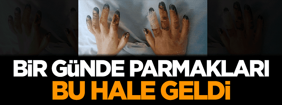 Bir günde parmakları bu hale geldi