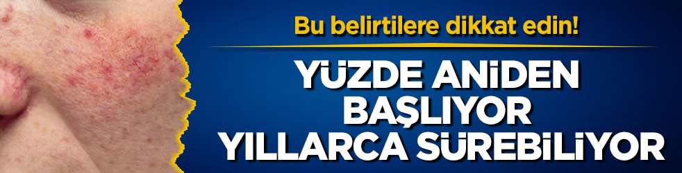 Bu belirtilere dikkat edin! Yüzde aniden başlıyor, yıllarca sürebiliyor