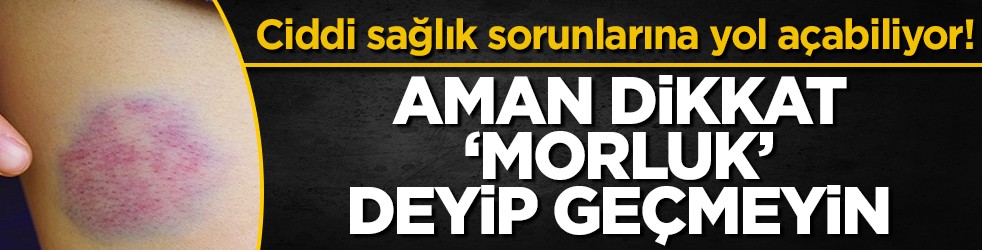 Ciddi sağlık sorunlarına yol açabiliyor! Aman dikkat 'Morluk' deyip geçmeyin